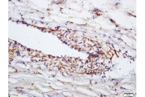 Formalin-fixed and paraffin embedded human lung carcinoma labeled with Anti-Phospho-eNOS (Ser1177)Polyclonal Antibody, Unconjugated  at 1:200 followed by conjugation to the secondary antibody and DAB staining (ENOS anticorps  (pSer1177))