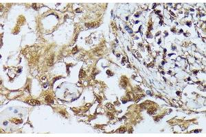 Immunohistochemistry of paraffin-embedded Human lung cancer using DAPK3 Polyclonal Antibody at dilution of 1:100 (40x lens). (DAPK3 anticorps)