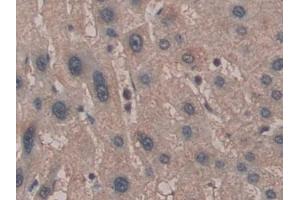 Detection of MYL2 in Human Liver cancer Tissue using Polyclonal Antibody to Myosin Light Chain 2 (MYL2)