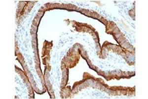 Epithelial Marker Antigen antibody IHC testing of formalin-paraffin human ovarian cancer tissue.