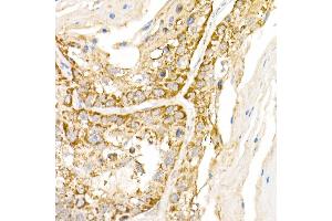 Immunohistochemistry of paraffin-embedded human lung cancer using B1 Rabbit pAb (ABIN6129916, ABIN6136962, ABIN6136963 and ABIN6222795) at dilution of 1:150 (40x lens). (AP3B1 anticorps  (AA 895-1094))