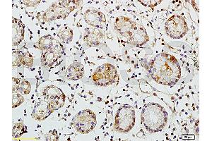 Formalin-fixed and paraffin embedded human colon carcinoma tissue labeled with Rabbit Anti-TEM1/CD248 Polyclonal Antibody (ABIN677573) at 1:200 followed by conjugation to the secondary antibody and DAB staining. (CD248 anticorps  (AA 251-350))