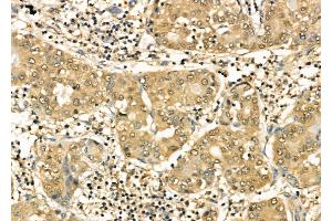 ABIN6264477 and ABIN6276991 at 1/100 staining Human liver cancer by IHC-P.