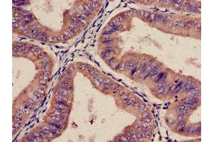 Immunohistochemistry of paraffin-embedded human endometrial cancer using ABIN7156430 at dilution of 1:100