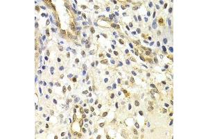 Immunohistochemistry of paraffin-embedded human uterine cancer using RAD50 Antibody. (RAD50 anticorps)