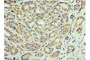 Immunohistochemistry of paraffin-embedded human breast cancer using ABIN7150549 at dilution of 1:100