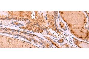 Immunohistochemistry of paraffin-embedded Human thyroid cancer tissue using HTRA4 Polyclonal Antibody at dilution of 1:35(x200) (HTRA4 anticorps)