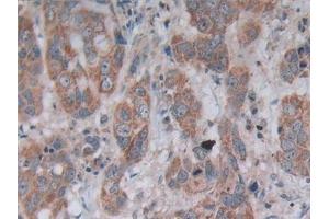 Detection of NT5C3 in Human Breast cancer Tissue using Polyclonal Antibody to 5'-Nucleotidase, Cytosolic III (NT5C3)