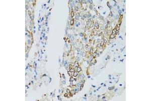 Immunohistochemistry of paraffin-embedded human lung cancer using SIRT2 antibody (ABIN5970103) at dilution of 1/100 (40x lens). (SIRT2 anticorps)