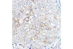 Immunohistochemistry of paraffin-embedded human breast cancer using TMPRSS2 Rabbit pAb (ABIN6132728, ABIN6149286, ABIN6149287 and ABIN6219138) at dilution of 1:50 (40x lens). (TMPRSS2 anticorps  (AA 140-400))