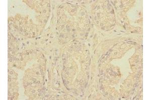 Immunohistochemistry of paraffin-embedded human prostate cancer using ABIN7161113 at dilution of 1:100 (nectin-3 anticorps  (AA 310-549))