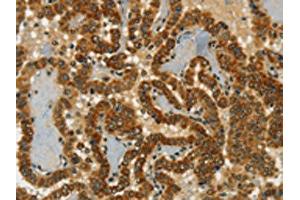 The image on the left is immunohistochemistry of paraffin-embedded Human thyroid cancer tissue using ABIN7190246(CHRDL2 Antibody) at dilution 1/20, on the right is treated with synthetic peptide.