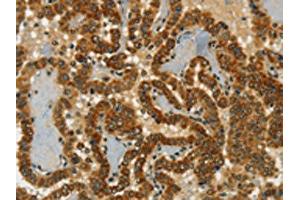 The image on the left is immunohistochemistry of paraffin-embedded Human thyroid cancer tissue using ABIN7190246(CHRDL2 Antibody) at dilution 1/20, on the right is treated with synthetic peptide. (CHRDL2 anticorps)