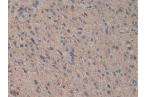 Detection of IL12A in Human Glioma Tissue using Monoclonal Antibody to Interleukin 12A (IL12A) (IL12A anticorps  (AA 23-219))