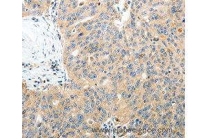 Immunohistochemistry of Human thyroid cancer using RAMP3 Polyclonal Antibody at dilution of 1:40