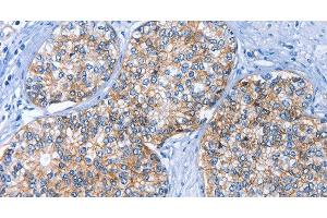 Immunohistochemistry of paraffin-embedded Human prostate cancer using CD239 Polyclonal Antibody at dilution of 1:40 (BCAM anticorps)