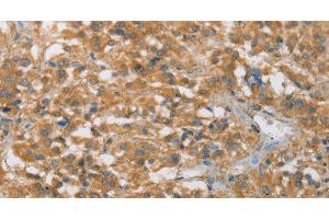 Immunohistochemistry of paraffin-embedded Human thyroid cancer tissue using FASLG Polyclonal Antibody at dilution 1:30 (FASL anticorps)