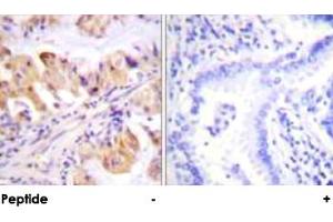 Immunohistochemical analysis of paraffin-embedded human lung carcinoma tissue using PTGES3 polyclonal antibody . (PTGES3 anticorps  (Ser113))