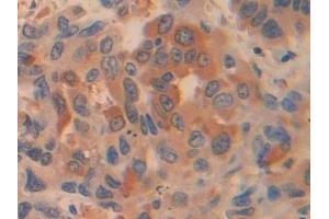 Detection of PKLR in Human Breast cancer Tissue using Polyclonal Antibody to Pyruvate kinase isozymes R/L (PKLR)