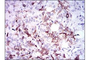 Immunohistochemical analysis of paraffin-embedded prostate cancer tissues using SPP1 mouse mAb with DAB staining.
