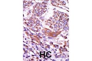 Formalin-fixed and paraffin-embedded human hepatocellular carcinoma tissue reacted with CAMK2D polyclonal antibody  , which was peroxidase-conjugated to the secondary antibody, followed by AEC staining. (CAMK2D anticorps  (C-Term))