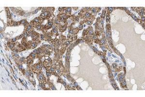 ABIN6269117 at 1/100 staining Human liver cancer tissue by IHC-P. (IGF1R anticorps  (C-Term))