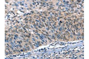 The image on the left is immunohistochemistry of paraffin-embedded Human cervical cancer tissue using ABIN7190052(CAMTA1 Antibody) at dilution 1/15, on the right is treated with synthetic peptide. (CAMTA1 anticorps)