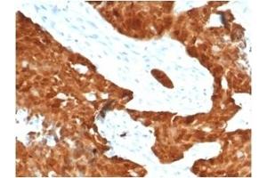Formalin-fixed, paraffin-embedded human ovarian carcinoma stained with P16INK4a Recombinant Rabbit Monoclonal Antibody (CDKN2A/7081R). (Recombinant CDKN2A anticorps)