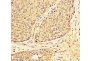 Immunohistochemistry of paraffin-embedded human ovarian cancer using ABIN7174303 at dilution of 1:100 (USP28 anticorps  (AA 430-580))