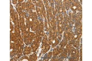 Immunohistochemistry of Human thyroid cancer using PTCH1 Polyclonal Antibody at dilution of 1:50 (Patched 1 anticorps)