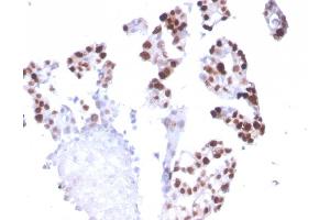 Formalin-fixed, paraffin-embedded human Breast Carcinoma stained with RNA Polymerase II / Poll II Mouse Monoclonal Antibody (CTD4H8). (POLR2A/RPB1 anticorps  (pSer5))