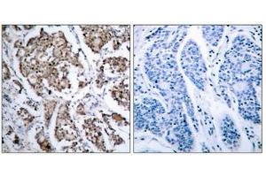 Immunohistochemical analysis of paraffin-embedded human breast carcinoma tissue using BAD (phospho- Ser155) antibody.