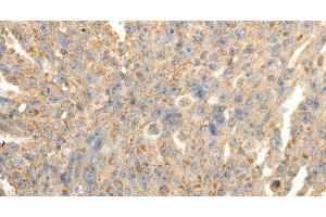 Immunohistochemistry of paraffin-embedded Human ovarian cancer tissue using SYT11 Polyclonal Antibody at dilution 1:30 (SYT11 anticorps)