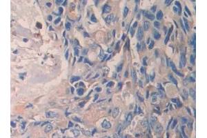 Detection of PAH in Human Breast cancer Tissue using Polyclonal Antibody to Phenylalanine Hydroxylase (PAH)