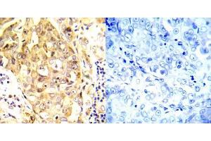 Immunohistochemical analysis of paraffin- embedded human breast carcinoma tissue using P53 (Ab-20) antibody (E022030). (p53 anticorps)