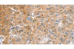 Immunohistochemistry of paraffin-embedded Human liver cancer tissue using CDR2 Polyclonal Antibody at dilution 1:60 (CDR2 anticorps)