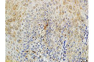 Formalin-fixed and paraffin embedded human endometrium carcinoma labeled with Rabbit Anti-Matriptase Polyclonal Antibody (ABIN669726), Unconjugated at 1:100 followed by conjugation to the secondary antibody and DAB staining. (ST14 anticorps  (AA 11-100))