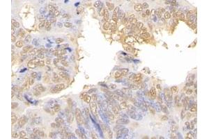 Detection of GAL3 in Human Colorectal cancer Tissue using Polyclonal Antibody to Galectin 3 (GAL3)