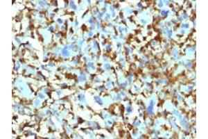 Immunohistochemical staining (Formalin-fixed paraffin-embedded sections) of human histiocytoma with F13A1 monoclonal antibody, clone F13A1/1448 . (F13A1 anticorps  (AA 46-181))