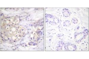 Immunohistochemistry analysis of paraffin-embedded human breast carcinoma, using PKC alpha (Phospho-Thr638) Antibody. (PKC alpha anticorps  (pThr638))