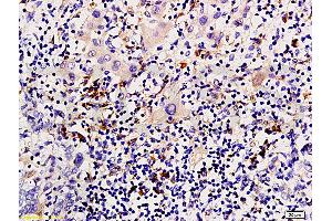 Formalin-fixed and paraffin embedded human liver carcinoma tissue labeled with Anti-P-CK/Cytokeratin AE1+AE3 Polyclonal Antibody, Unconjugated (ABIN733343) at 1:200 followed by conjugation to the secondary antibody and DAB staining