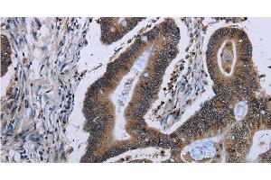 Immunohistochemistry of paraffin-embedded Human ovarian cancer tissue using ITGAE Polyclonal Antibody at dilution of 1:50 (CD103 anticorps)