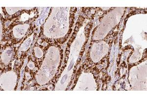 ABIN6266447 at 1/100 staining Human thyroid cancer tissue by IHC-P. (RYR2 anticorps  (Internal Region))