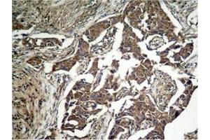Immunohistochemical analysis of paraffin-embedded human lung carcinoma tissue, using eIF2α (Phospho-Ser51) Antibody.