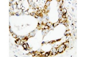 IHC-P: MEK3 antibody testing of human breast cancer tissue (MAP2K3 anticorps  (C-Term))