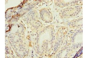Immunohistochemistry of paraffin-embedded human breast cancer using ABIN7175174 at dilution of 1:100 (RAD23B anticorps  (AA 1-250))
