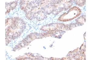 Formalin-fixed, paraffin-embedded human Prostate Carcinoma stained with AKR1C2 Mouse Monoclonal Antibody (CPTC-AKR1C2-1).