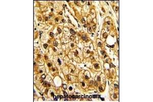 Formalin-fixed and paraffin-embedded human hepatocarcinoma with ITGAX Antibody (C-term), which was peroxidase-conjugated to the secondary antibody, followed by DAB staining.