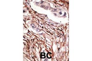 Formalin-fixed and paraffin-embedded human breast cancer tissue reacted with NOTCH3 polyclonal antibody  , which was peroxidase-conjugated to the secondary antibody, followed by DAB staining. (NOTCH3 anticorps  (C-Term))
