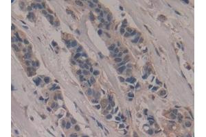 Detection of PVR in Human Breast cancer Tissue using Polyclonal Antibody to Poliovirus Receptor (PVR)